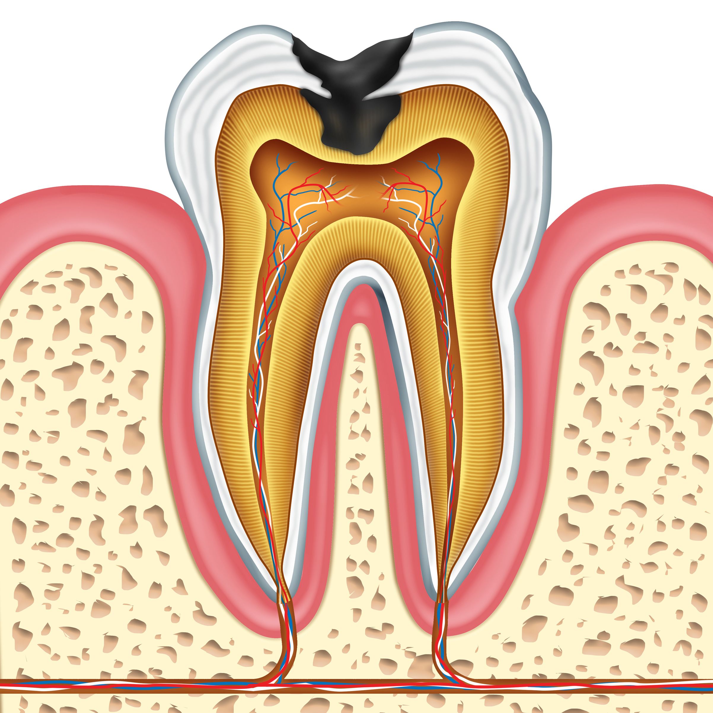 root canal