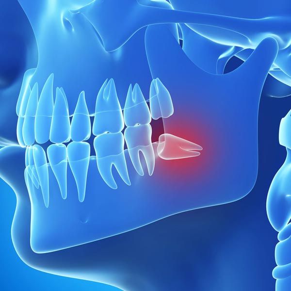 Digital image of painful wisdom tooth