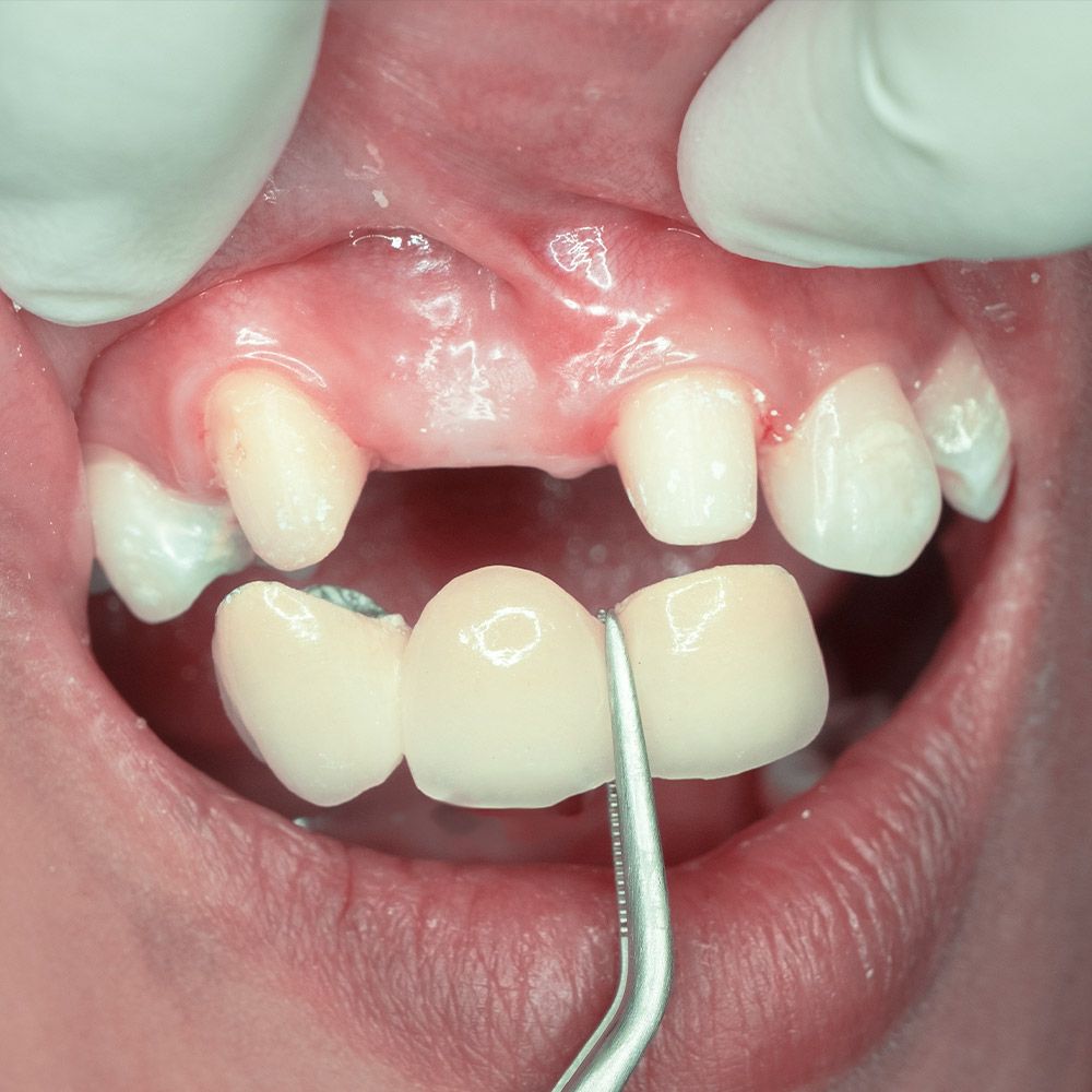 dental bridge